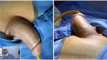 28-10-2024-penile_prosthesis_implant_infrapubic_approach