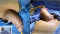 28-10-2024-penile_prosthesis_implant_infrapubic_approach